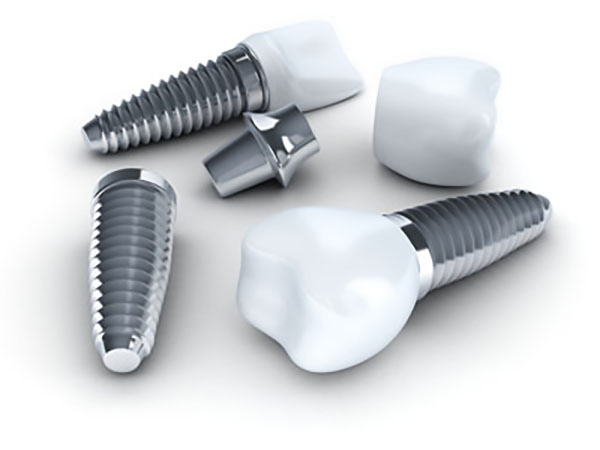 Advantages Of The All On  ® Dental Implant