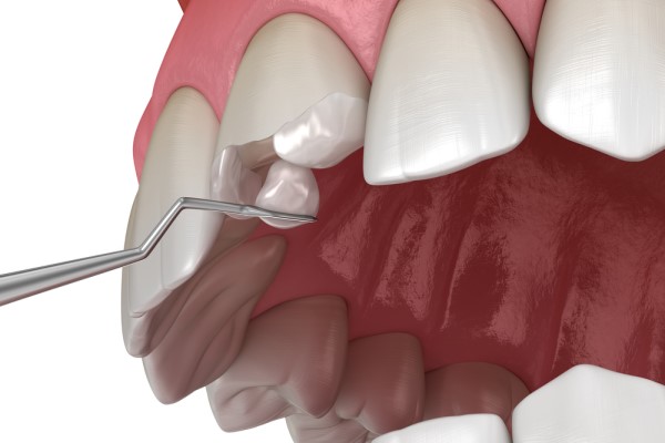 When A Broken Tooth Becomes A Dental Emergency