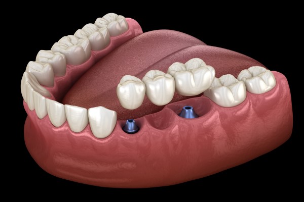 How A Bridge Dental Restoration Replaces One Or More Missing Teeth