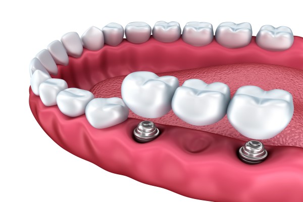 Benefits Of Choosing A Multiple Tooth Implant