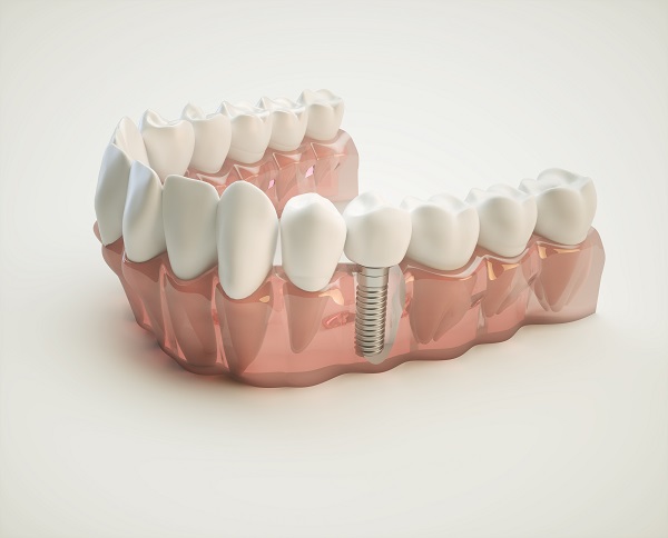 dental implants Chicago, IL