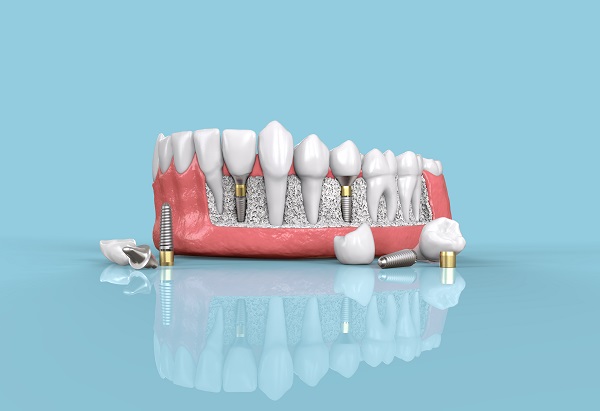 The Role Of The Jawbone In Dental Implant Placement