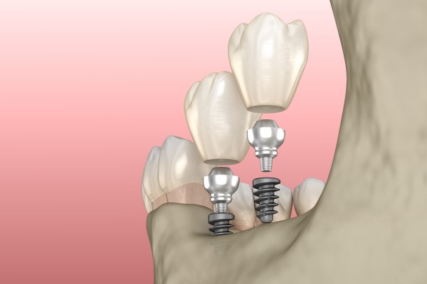 Dental Implants Chicago, IL