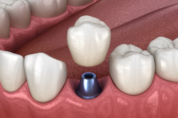 Repair Your Smile With Permanent Tooth Replacement