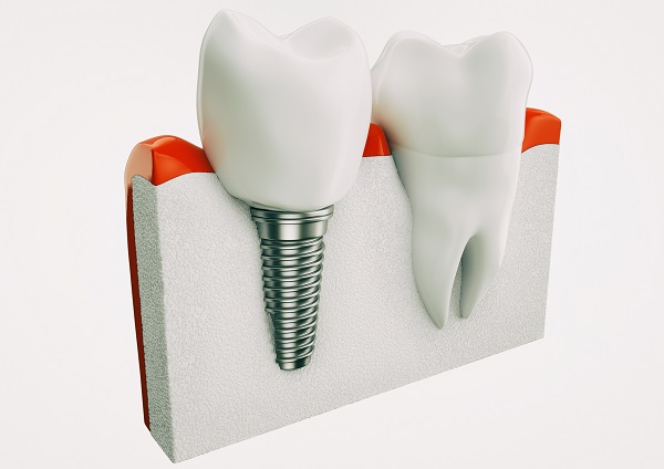 dental implant Chicago, IL