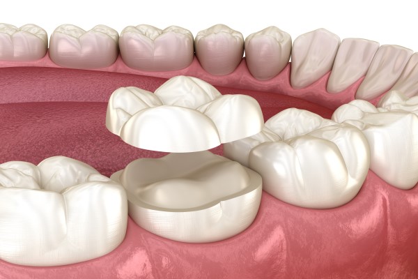 When Is A Dental Onlay Better Than A Crown?