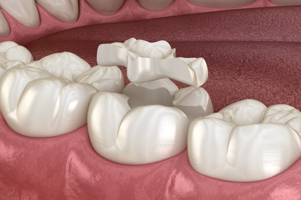 Fixed Dentistry: Inlays And Onlays For Restoring A Tooth