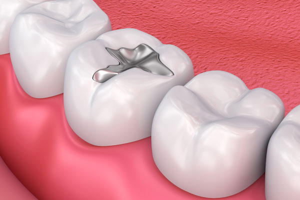 Dental Restorations: Choosing Between Fillings and Crowns from Smiles On Michigan in Chicago, IL