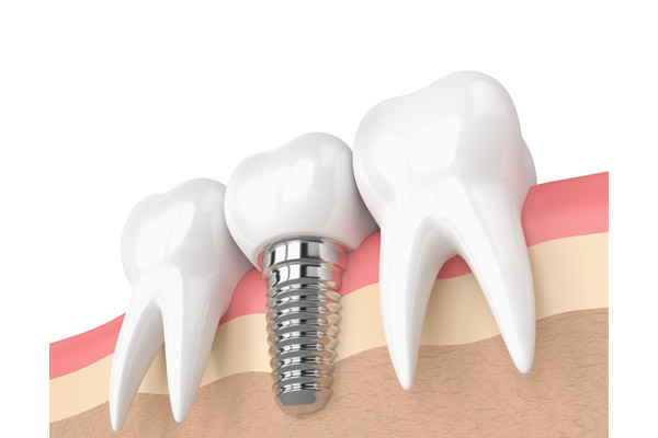 How Bone Grafts Are Important For Dental Implants