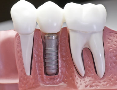 Learn How An Implant Dentist Can Replace Your Ill Fitting Dentures