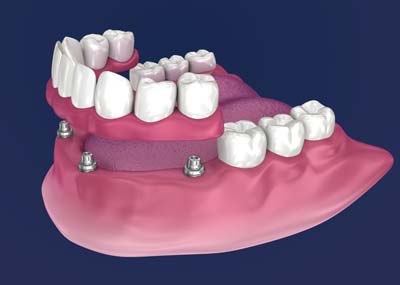 You Might Be A Good Candidate For Implant Supported Dentures