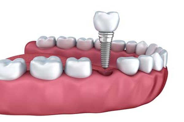Modern Tooth Replacement: Implant Dentistry By Smiles On Michigan